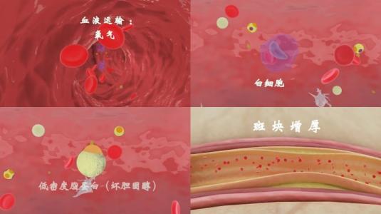 高血脂