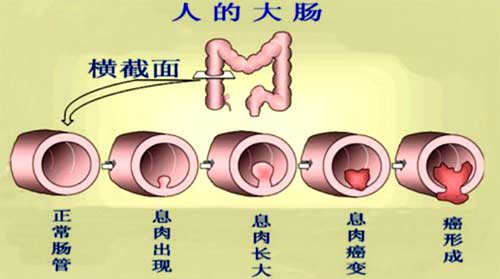 负离子疗法可以有效缓解和预防癌症
