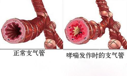 负离子疗法可以有效预防和治疗哮喘