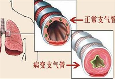 气管炎如何根治